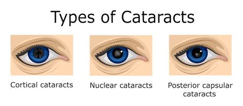 What are the Main Types of Cataracts? | New York Eye Doctor