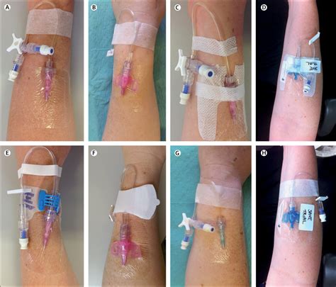 Dressings and securements for the prevention of peripheral intravenous catheter failure in ...