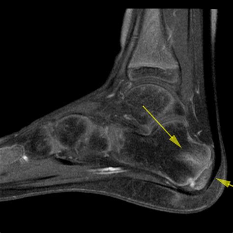 Calcaneal apophysitis (Sever disease) | Image | Radiopaedia.org