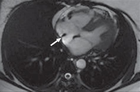 Normal cardiac MRI anatomy shown in healthy subject. Axial fast imaging... | Download Scientific ...