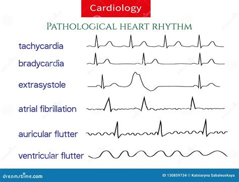 Collection Pathologique D'ecg Illustration Stock - Illustration du ...