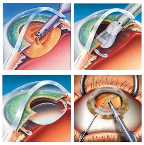 Microincision Cataract Surgery (MICS) - Eyemantra Cataract Eye Surgery