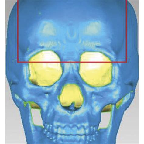 Difference of frontal bone and supraorbital margin between male and ...