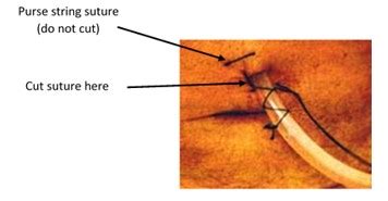 Low Continuous Suction for Chest Tube - Trinidad Forombity