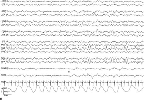 Neonatal Eeg Bird