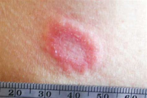 Mold on Skin: Causes, Symptoms & Treatment - Mold Blogger