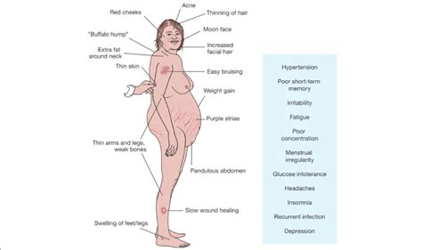 Signs and symptoms of Cushing's disease | Download Scientific Diagram