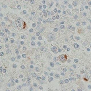 Reed-Sternberg cell positive for CD30 (Immunohistochemistry X400 ...