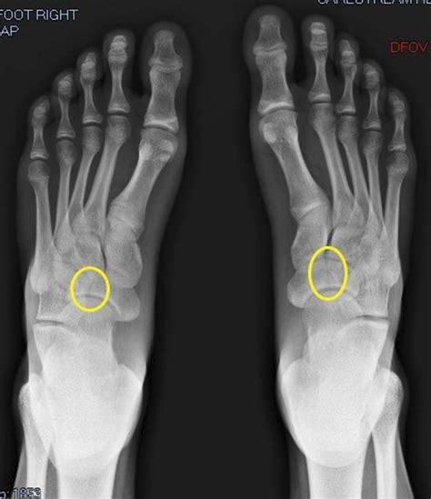 Xray Of Foot Stress Fracture