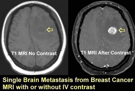 Can an MRI without contrast dye vs with contrast dye make a huge difference? - Quora