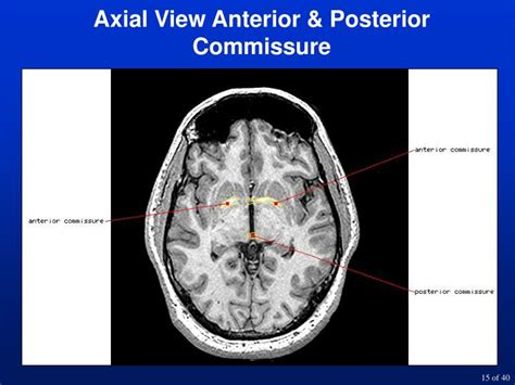 PPT - Lecture 4-Neuroanatomy Walter Schneider PowerPoint Presentation ...