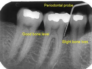 Periodontal Examination – Periodontist, Periodontal Surgery, Lantana, FL