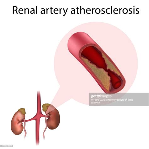 Renal Artery Atherosclerosis Illustration High-Res Stock Photo - Getty Images