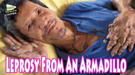 Leprosy From An Armadillo - YouTube