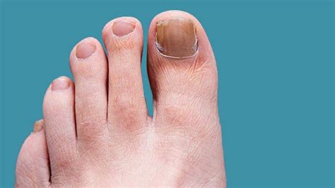 What is Toenail Fungus? - Daily Health And Beauty Tips