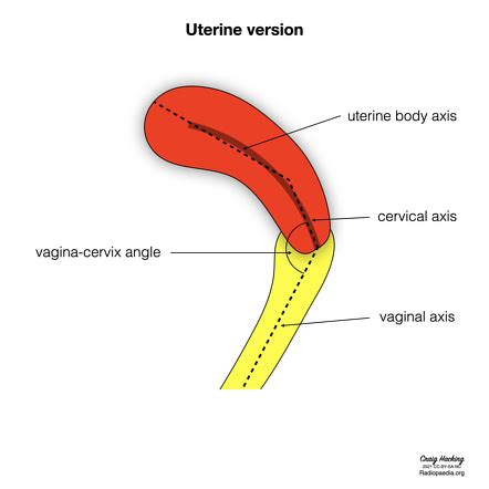Uterine version and flexion (diagrams) | Radiology Case | Radiopaedia.org
