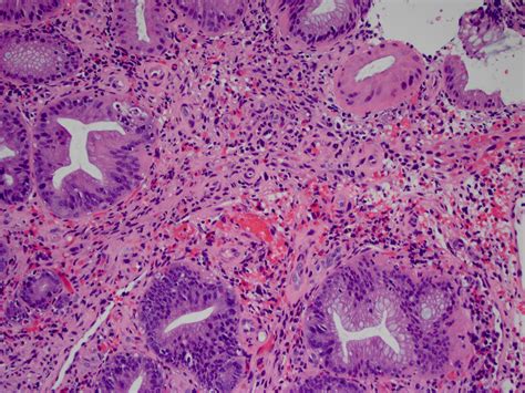 Pathology Outlines - Kaposi sarcoma