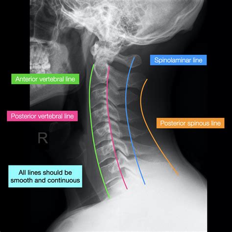 Anatomy Chart Lateral Cervical Spine Conditions Label - vrogue.co