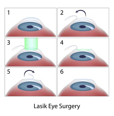 LASIK para Astigmatismo (Procedimiento, Beneficios y Cuánto Cuesta) | Promo Integra