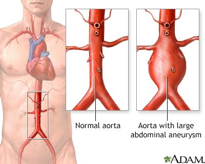 Abdominal mass Information | Mount Sinai - New York