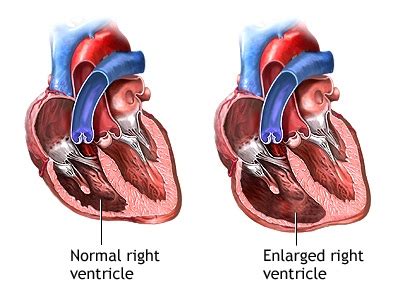 Tricuspid Regurgitation: Causes, Symptoms, Treatment | New Health Advisor