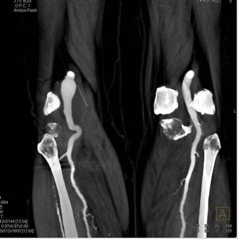 Right Popliteal Artery Aneurysm - Vascular Case Studies - CTisus CT Scanning