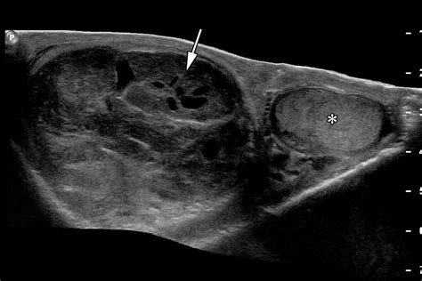 Testicular Seminoma Ultrasound