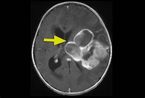 Pediatric Brain Tumors: Imaging Matters