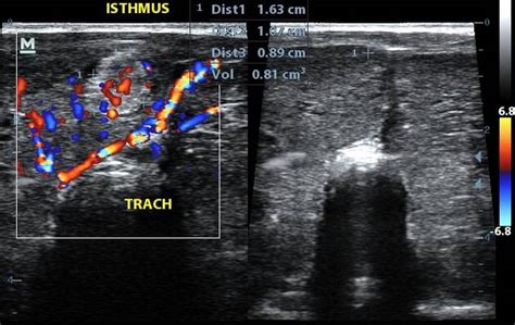 Multinodular Goiter Ultrasound