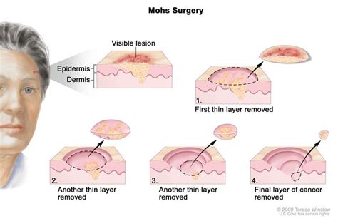 Skin Cancer Treatment - NCI