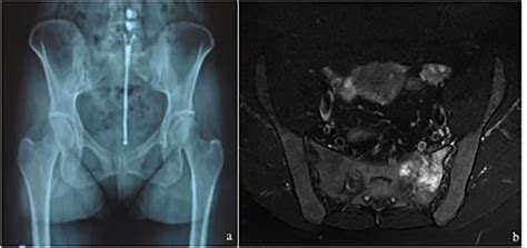 Sneezing: A Rare Cause of Sacral Insufficiency Fracture in a Young ...