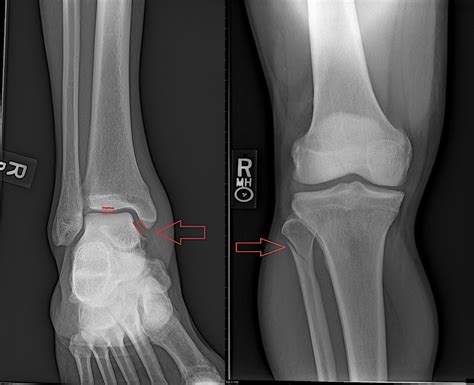 Tibia And Fibula Ankle Fracture