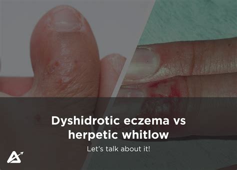 Dyshidrotic eczema vs herpetic whitlow - Anam Cara