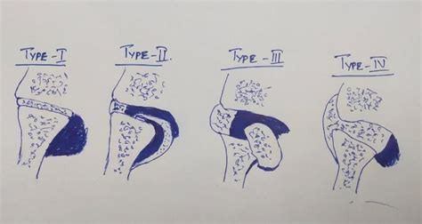 TMJ Ankylosis – Types, Classification, Aetiology, Diagnosis, Clinical ...