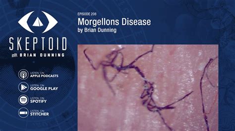 Morgellons Disease Symptoms