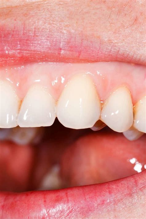 Pale gums: Causes, symptoms, treatment, and warning signs
