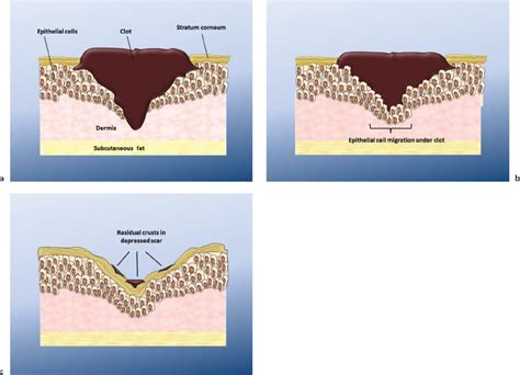 2 Wound Healing | Plastic Surgery Key