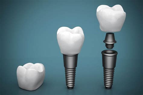 Implants and Oral Surgery at Countryside Smiles