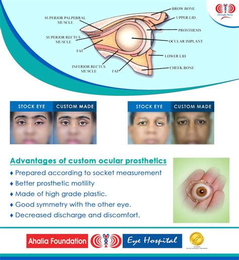 Prosthetic Eye - Ahalia Foundation Eye Hospital