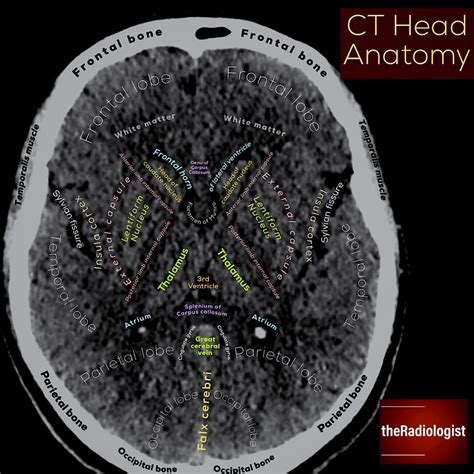 Axial Slice of a Non-Contrast CT Head at the Level of the Basal Ganglia