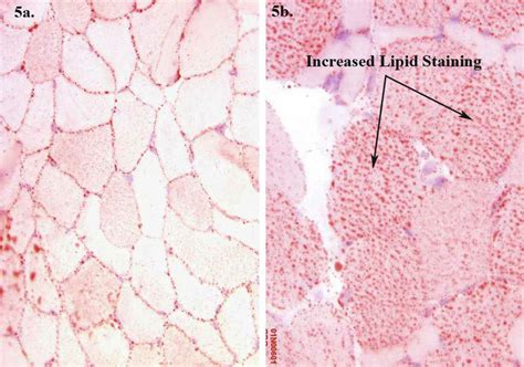 Oil Red O. (a) Normal lipid staining (total magnification, × 200). (b ...