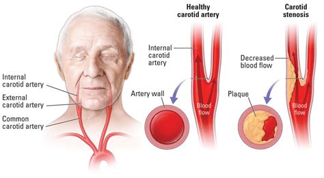 Carotid Arterial Disease | Vascular & Interventional Centre