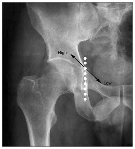 Superior Pubic Ramus Fracture