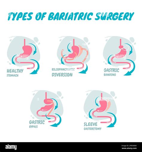 Types of bariatric surgery, it is process for the digestive system in ...