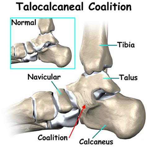 Tarsal coalition causes, symptoms, diagnosis & treatment