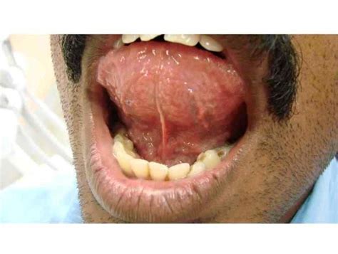 Photos of oral cancer on floor of mouth