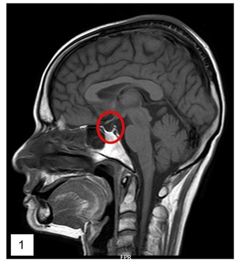 Cureus | The Emptiness Within: A Case of Empty Sella Syndrome