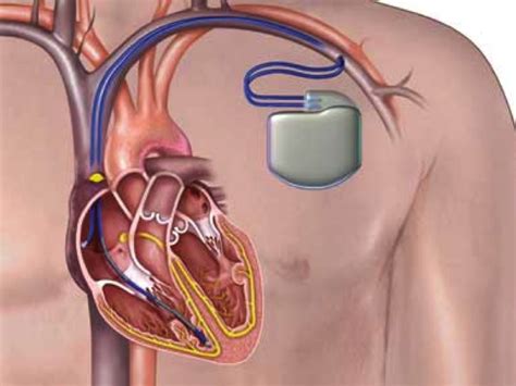 Implantable Cardioverter Defibrillator (ICD) - Dr Matthew Ginks