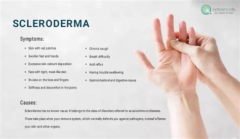 Scleroderma Symptoms, Types, and Available Treatment - Social Social Social | Social Social Social