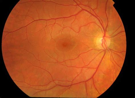 Paracentral Scotoma - Outlook Eye Specialists